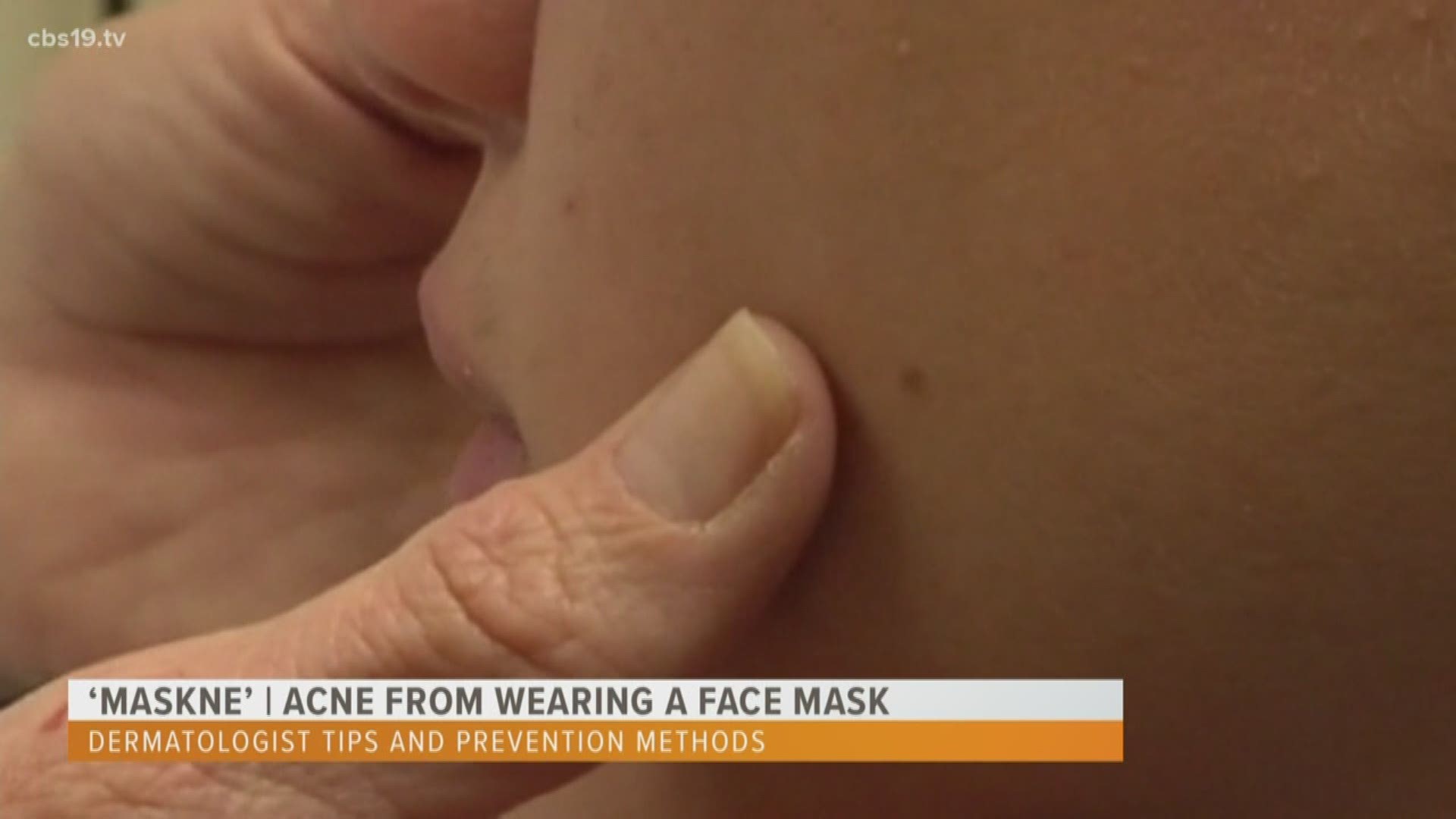 Wearing a mask could be causing something called 'maskne.' A Tyler dermatologist explains how to treat and avoid it.