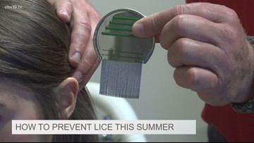 Stop Scratching Your Head How To Prevent Lice This Summer Cbs19 Tv