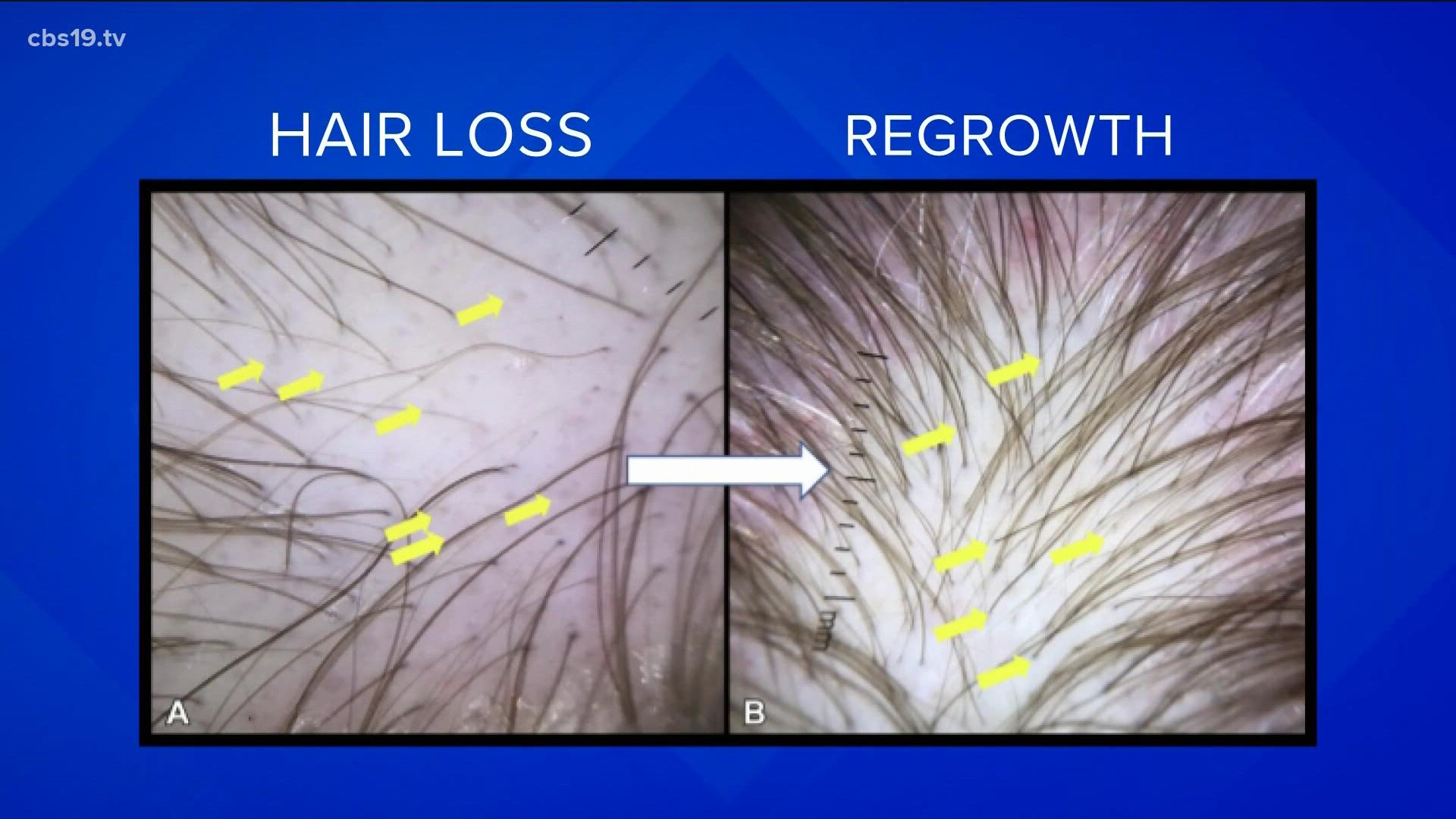 Telogen Effluvium is a condition that causes hair loss after a stressful experience.