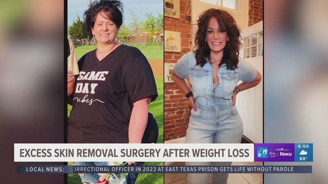 Texas woman shares weight loss, skin removal journey on TikTok